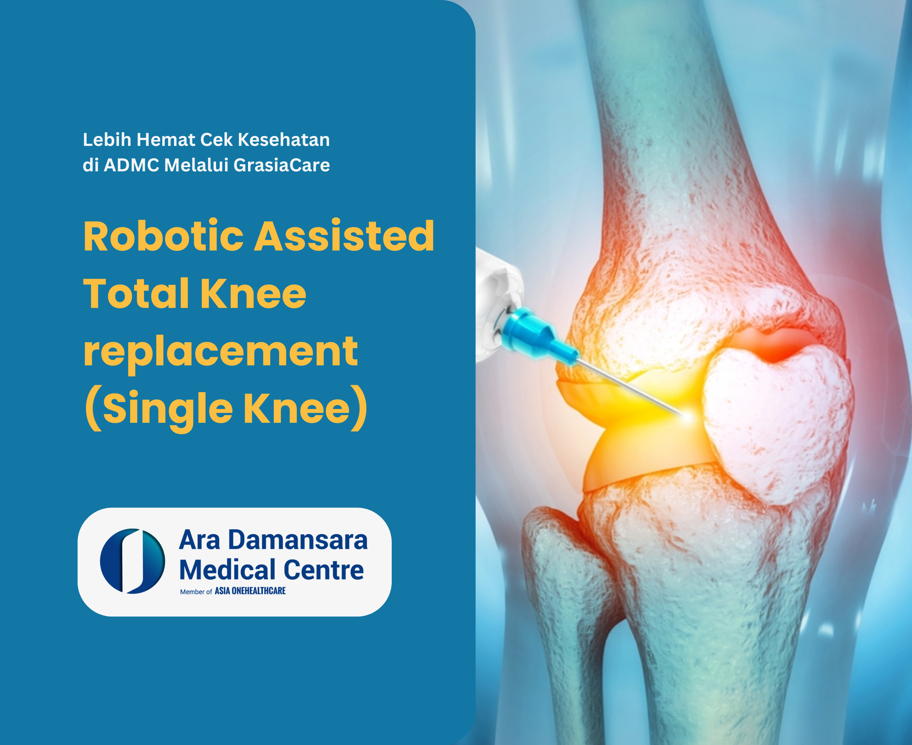 Robotic Assisted Total Knee replacement (Single Knee)